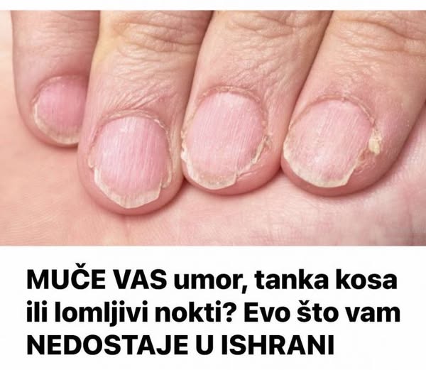 MUČE VAS umor, tanka kosa ili lomljivi nokti? Evo što vam NEDOSTAJE U ISHRANI - featured image