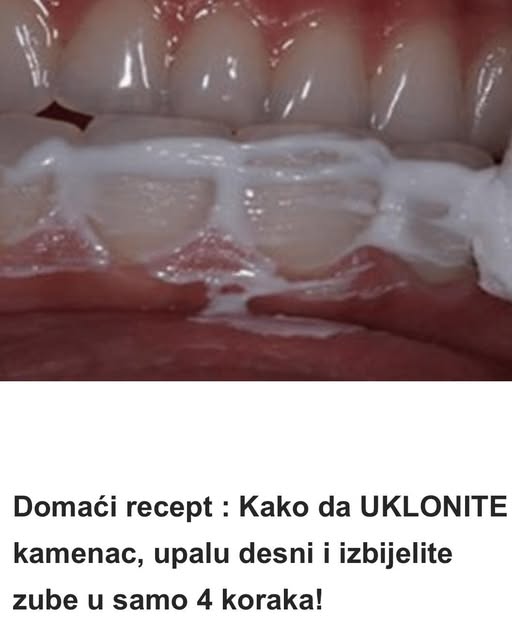 Domaći recept : Kako da UKLONITE kamenac, upalu desni i izbijelite zube u samo 4 koraka! - featured image