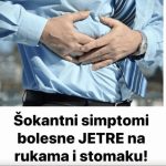 Šokantni simptomi bolesne JETRE na rukama i stomaku Šokantni simptomi bolesne JETRE na rukama i stomaku - featured image