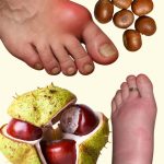 DIVLJI KESTEN – moćan lijek za otečene noge i bolju cirkulaciju DIVLJI KESTEN – moćan lijek za otečene noge i bolju cirkulaciju - featured image