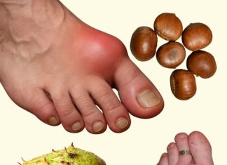 DIVLJI KESTEN – moćan lijek za otečene noge i bolju cirkulaciju DIVLJI KESTEN – moćan lijek za otečene noge i bolju cirkulaciju - featured image