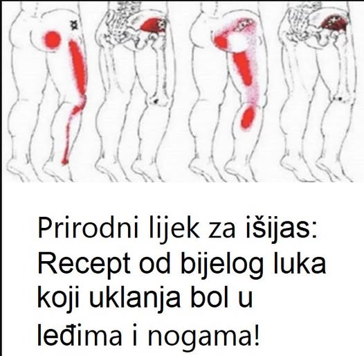 Prirodni lijek za išijas: Recept od bijelog luka koji uklanja bol u leđima i nogama - featured image Prirodni lijek za išijas: Recept od bijelog luka koji uklanja bol u leđima i nogama - featured image