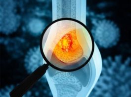 Tihi simptomi raka kostiju: Kakav bol i u kom delu tela može da bude alarm upozorenja Tihi simptomi raka kostiju: Kakav bol i u kom delu tela može da bude alarm upozorenja - featured image