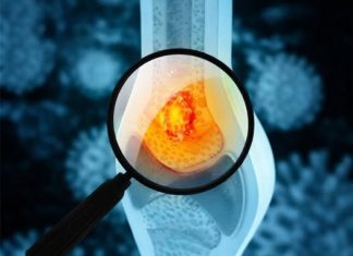 Tihi simptomi raka kostiju: Kakav bol i u kom delu tela može da bude alarm upozorenja Tihi simptomi raka kostiju: Kakav bol i u kom delu tela može da bude alarm upozorenja - featured image