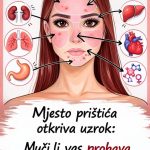 Mjesto prištića otkriva uzrok: Muči li vas probava ili hormoni Mjesto prištića otkriva uzrok: Muči li vas probava ili hormoni - featured image
