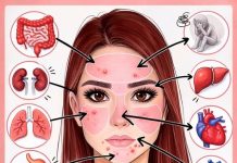 Mjesto prištića otkriva uzrok: Muči li vas probava ili hormoni Mjesto prištića otkriva uzrok: Muči li vas probava ili hormoni - featured image