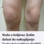 Voda u koljenu: Zašto dolazi do nakupljanja i kako taj problem riješiti? Voda u koljenu: Zašto dolazi do nakupljanja i kako taj problem riješiti? - featured image