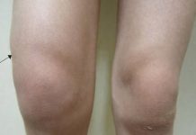 Voda u koljenu: Zašto dolazi do nakupljanja i kako taj problem riješiti? Voda u koljenu: Zašto dolazi do nakupljanja i kako taj problem riješiti? - featured image