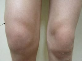 Voda u koljenu: Zašto dolazi do nakupljanja i kako taj problem riješiti? Voda u koljenu: Zašto dolazi do nakupljanja i kako taj problem riješiti? - featured image