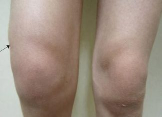 Voda u koljenu: Zašto dolazi do nakupljanja i kako taj problem riješiti? Voda u koljenu: Zašto dolazi do nakupljanja i kako taj problem riješiti? - featured image