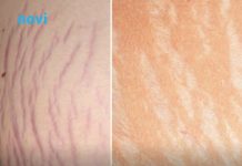 Jedna biljka kao skalpelom briše sve ožiljke, opekotine i strije, a koža se podmlađuje Jedna biljka kao skalpelom briše sve ožiljke, opekotine i strije, a koža se podmlađuje - featured image