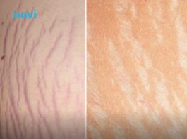 Jedna biljka kao skalpelom briše sve ožiljke, opekotine i strije, a koža se podmlađuje Jedna biljka kao skalpelom briše sve ožiljke, opekotine i strije, a koža se podmlađuje - featured image