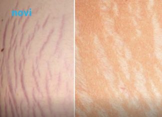 Jedna biljka kao skalpelom briše sve ožiljke, opekotine i strije, a koža se podmlađuje Jedna biljka kao skalpelom briše sve ožiljke, opekotine i strije, a koža se podmlađuje - featured image