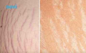 Jedna biljka kao skalpelom briše sve ožiljke, opekotine i strije, a koža se podmlađuje Jedna biljka kao skalpelom briše sve ožiljke, opekotine i strije, a koža se podmlađuje - featured image