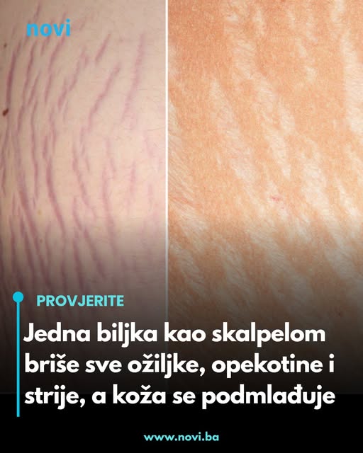 Jedna biljka kao skalpelom briše sve ožiljke, opekotine i strije, a koža se podmlađuje - featured image Jedna biljka kao skalpelom briše sve ožiljke, opekotine i strije, a koža se podmlađuje - featured image