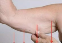 EVO ZAŠTO IMATE NEOBIČNO OBJEŠENU KOŽU- Većina ljudi nema pojma o ovom problemu. Jedino efikasno rješenje je ovaj domaći trik