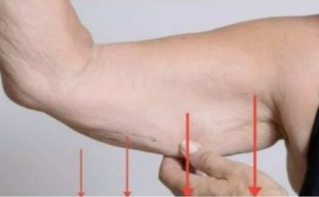 EVO ZAŠTO IMATE NEOBIČNO OBJEŠENU KOŽU- Većina ljudi nema pojma o ovom problemu. Jedino efikasno rješenje je ovaj domaći trik