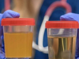 BOJA URINA otkriva mnoge ozbiljne bolesti, pa čak i one NAJTEŽE – Ovo je RAZLOG mutne mokraće!