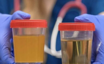 BOJA URINA otkriva mnoge ozbiljne bolesti, pa čak i one NAJTEŽE – Ovo je RAZLOG mutne mokraće!
