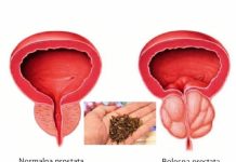 Spas za muškarce: Riješite probleme prostate na prirodan način! Spas za muškarce: Riješite probleme prostate na prirodan način! - featured image