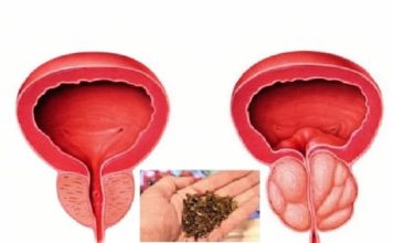 Spas za muškarce: Riješite probleme prostate na prirodan način! Spas za muškarce: Riješite probleme prostate na prirodan način! - featured image