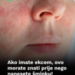 Ako imate ekcem, ovo morate znati prije nego nanesete šminku! Ako imate ekcem, ovo morate znati prije nego nanesete šminku! - featured image
