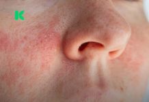 Ako imate ekcem, ovo morate znati prije nego nanesete šminku! Ako imate ekcem, ovo morate znati prije nego nanesete šminku! - featured image