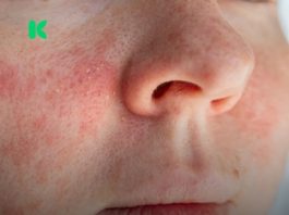 Ako imate ekcem, ovo morate znati prije nego nanesete šminku! Ako imate ekcem, ovo morate znati prije nego nanesete šminku! - featured image