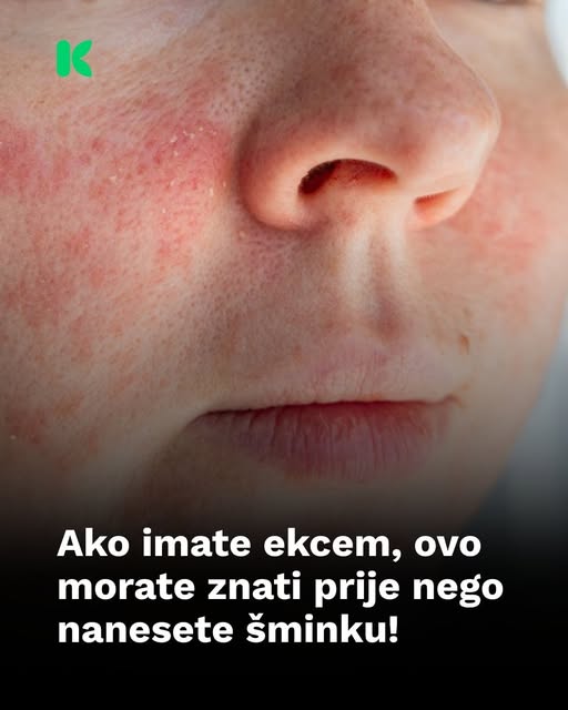 Ako imate ekcem, ovo morate znati prije nego nanesete šminku! - featured image