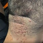 Kako prepoznati simptome i zaštititi seInfekcija nakon šišanja