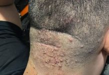 Kako prepoznati simptome i zaštititi seInfekcija nakon šišanja