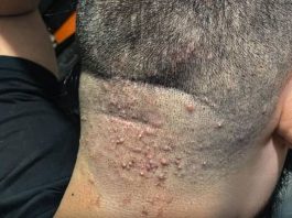 Kako prepoznati simptome i zaštititi seInfekcija nakon šišanja