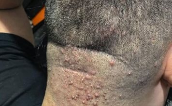 Kako prepoznati simptome i zaštititi seInfekcija nakon šišanja