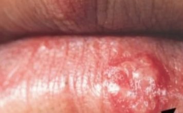 NAGLI PAD IMUNITET I POJAVA HERPESA: Objavljen jednostavan trik za uklanjanje, OVO PROBAJTE ODMAH NAGLI PAD IMUNITET I POJAVA HERPESA: Objavljen jednostavan trik za uklanjanje, OVO PROBAJTE ODMAH - featured image