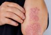 NIKAD VIŠE NEĆETE BACITI KORU OD OVE VOĆKE: Liječi psorijazu, skida bradavice i izbjeljuje zube NIKAD VIŠE NEĆETE BACITI KORU OD OVE VOĆKE: Liječi psorijazu, skida bradavice i izbjeljuje zube - featured image
