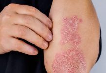 NIKAD VIŠE NEĆETE BACITI KORU OD OVE VOĆKE: Liječi psorijazu, skida bradavice i izbjeljuje zube NIKAD VIŠE NEĆETE BACITI KORU OD OVE VOĆKE: Liječi psorijazu, skida bradavice i izbjeljuje zube - featured image