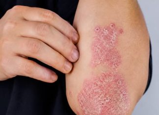 NIKAD VIŠE NEĆETE BACITI KORU OD OVE VOĆKE: Liječi psorijazu, skida bradavice i izbjeljuje zube NIKAD VIŠE NEĆETE BACITI KORU OD OVE VOĆKE: Liječi psorijazu, skida bradavice i izbjeljuje zube - featured image