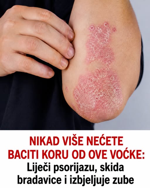 NIKAD VIŠE NEĆETE BACITI KORU OD OVE VOĆKE: Liječi psorijazu, skida bradavice i izbjeljuje zube - featured image