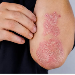 NIKAD VIŠE NEĆETE BACITI KORU OD OVE VOĆKE: Liječi psorijazu, skida bradavice i izbjeljuje zube