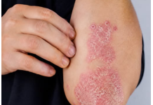 NIKAD VIŠE NEĆETE BACITI KORU OD OVE VOĆKE: Liječi psorijazu, skida bradavice i izbjeljuje zube