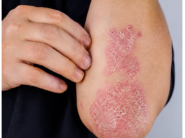NIKAD VIŠE NEĆETE BACITI KORU OD OVE VOĆKE: Liječi psorijazu, skida bradavice i izbjeljuje zube