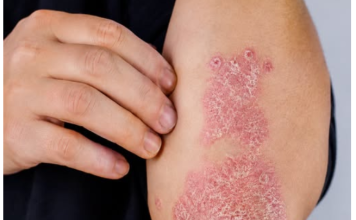 NIKAD VIŠE NEĆETE BACITI KORU OD OVE VOĆKE: Liječi psorijazu, skida bradavice i izbjeljuje zube