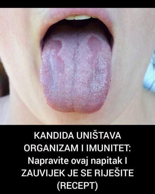 KANDIDA UNIŠTAVA ORGANIZAM I IMUNITET: Napravite ovaj napitak I ZAUVIJEK JE SE RIJEŠITE (RECEPT) - featured image
